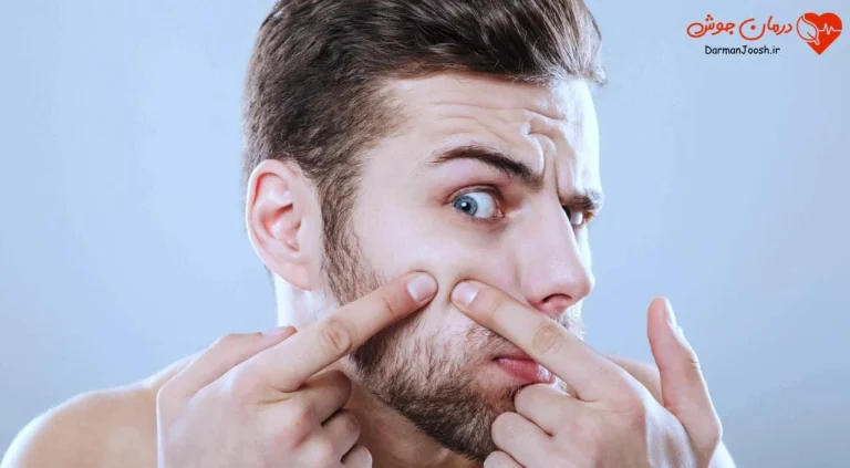 ویکس برای جوش صورت خوب است یا بد؟