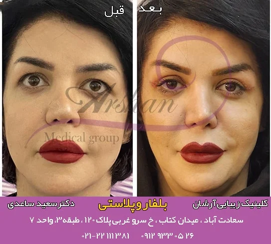 بلفاروپلاستی | جراحی | عمل جراحی