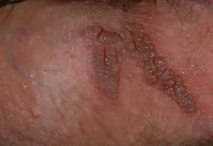 زگیل تناسلی