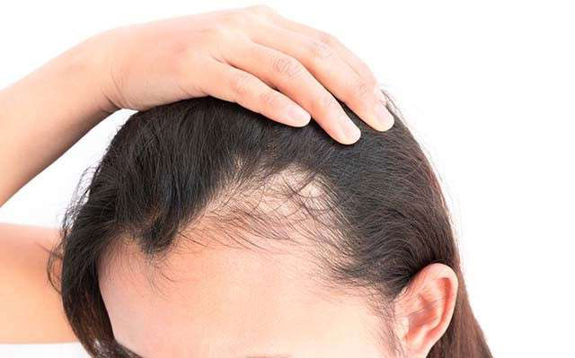 The best way to prevent male hair loss