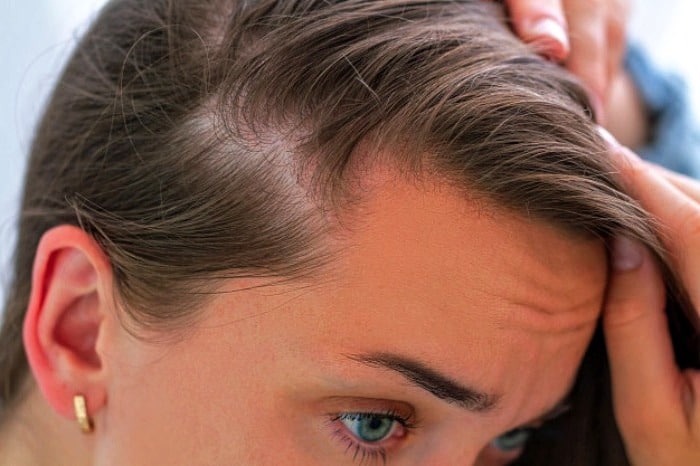 What are the symptoms of hereditary hair loss and is there a treatment?